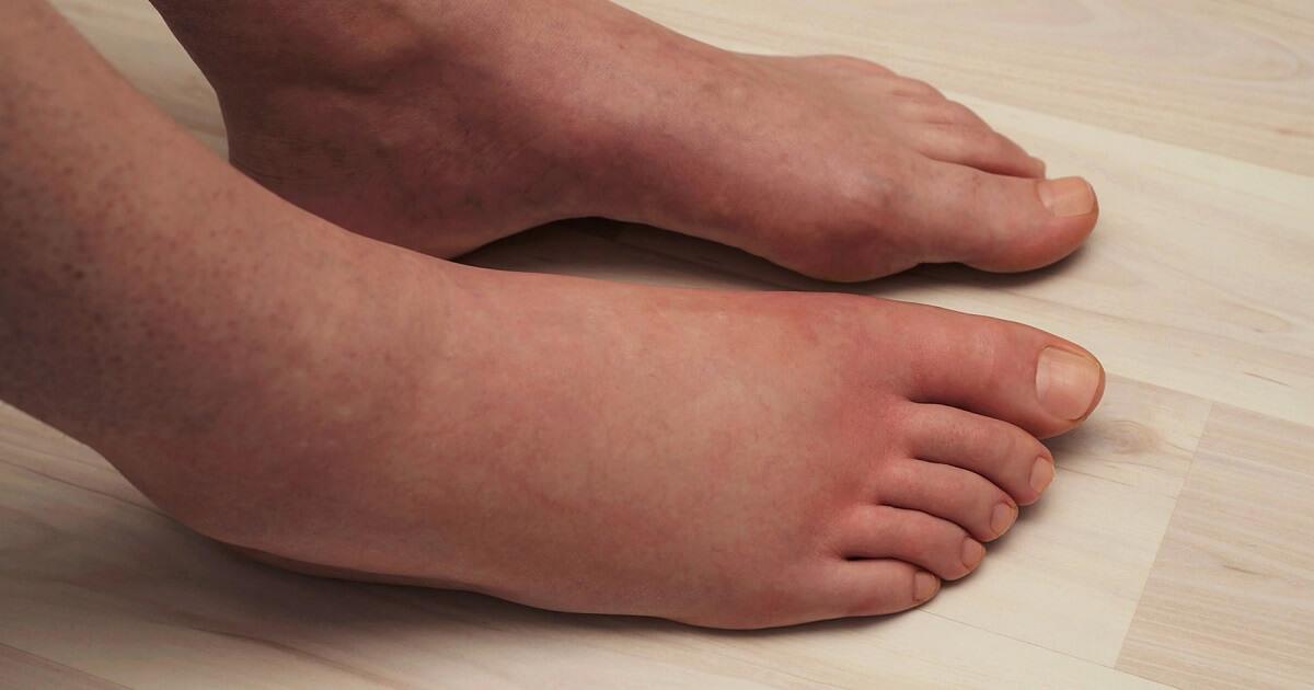 What to Do With Swollen Legs After Surgery What to Do With Swollen Legs After Surgery