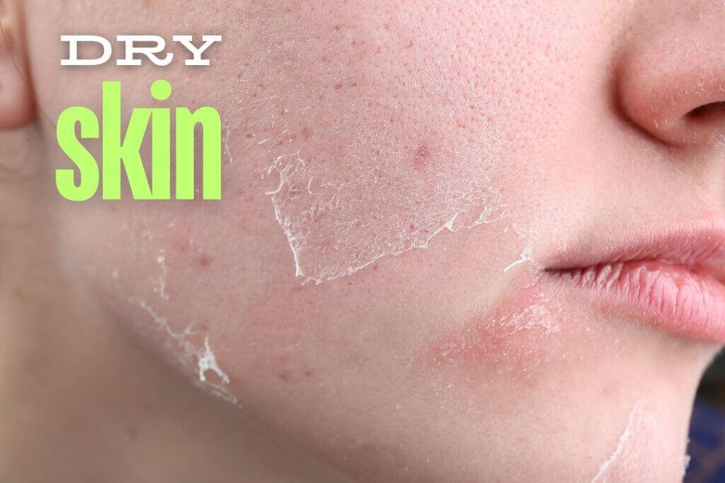 Natural Remedies for Dry Skin