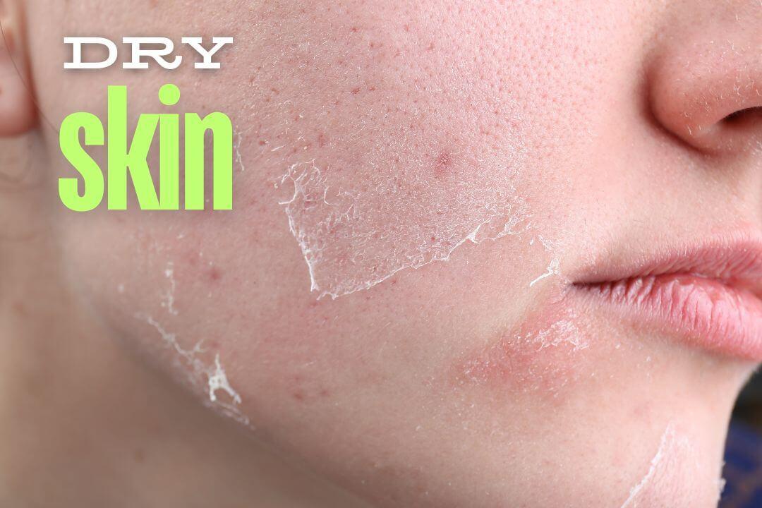 Natural Remedies for Dry Skin